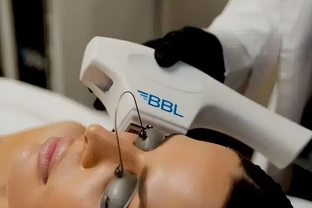 BBL Laser Treatments: Transform Your Skin with Broadband Light Therapy in Salt Lake City