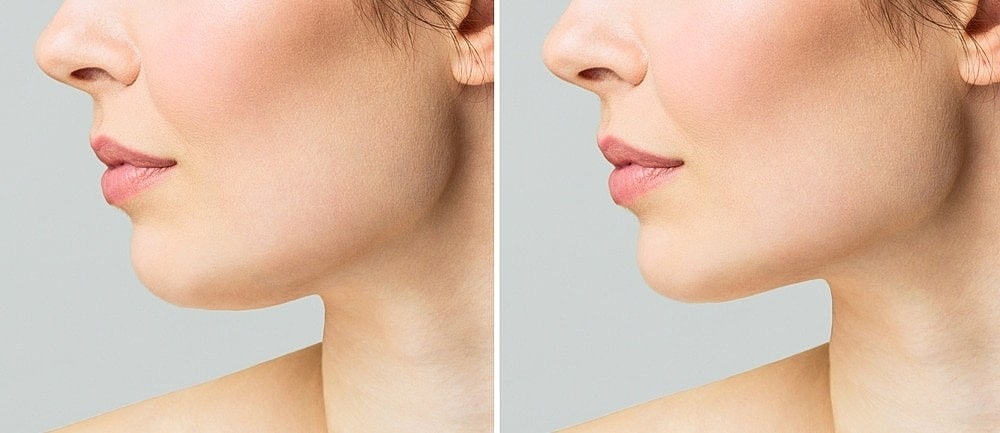 Goodbye Double Chin: Understanding the Power of Kybella Injections in Salt Lake City