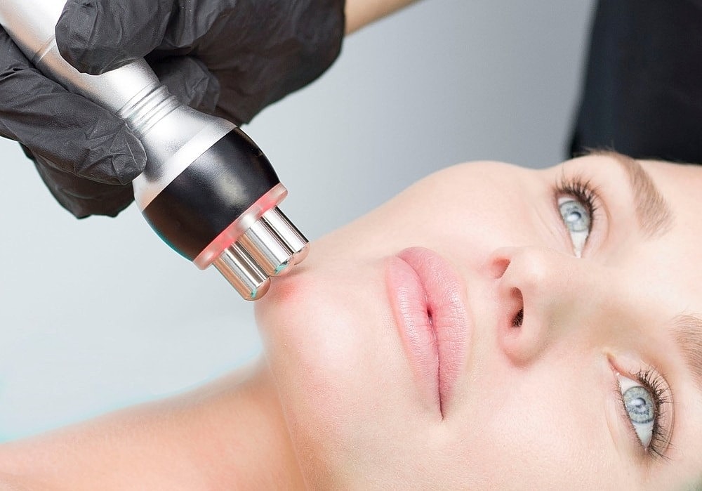 Understanding RF Cautery: The Concept Behind Skin Imperfection Removal