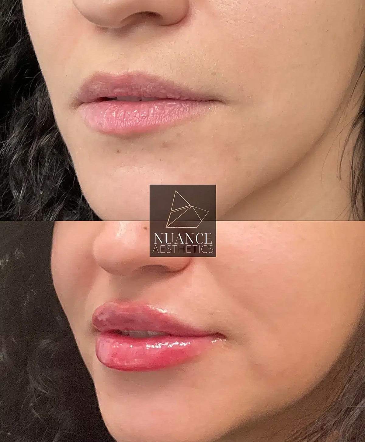 Before and after lip enhancement comparison.