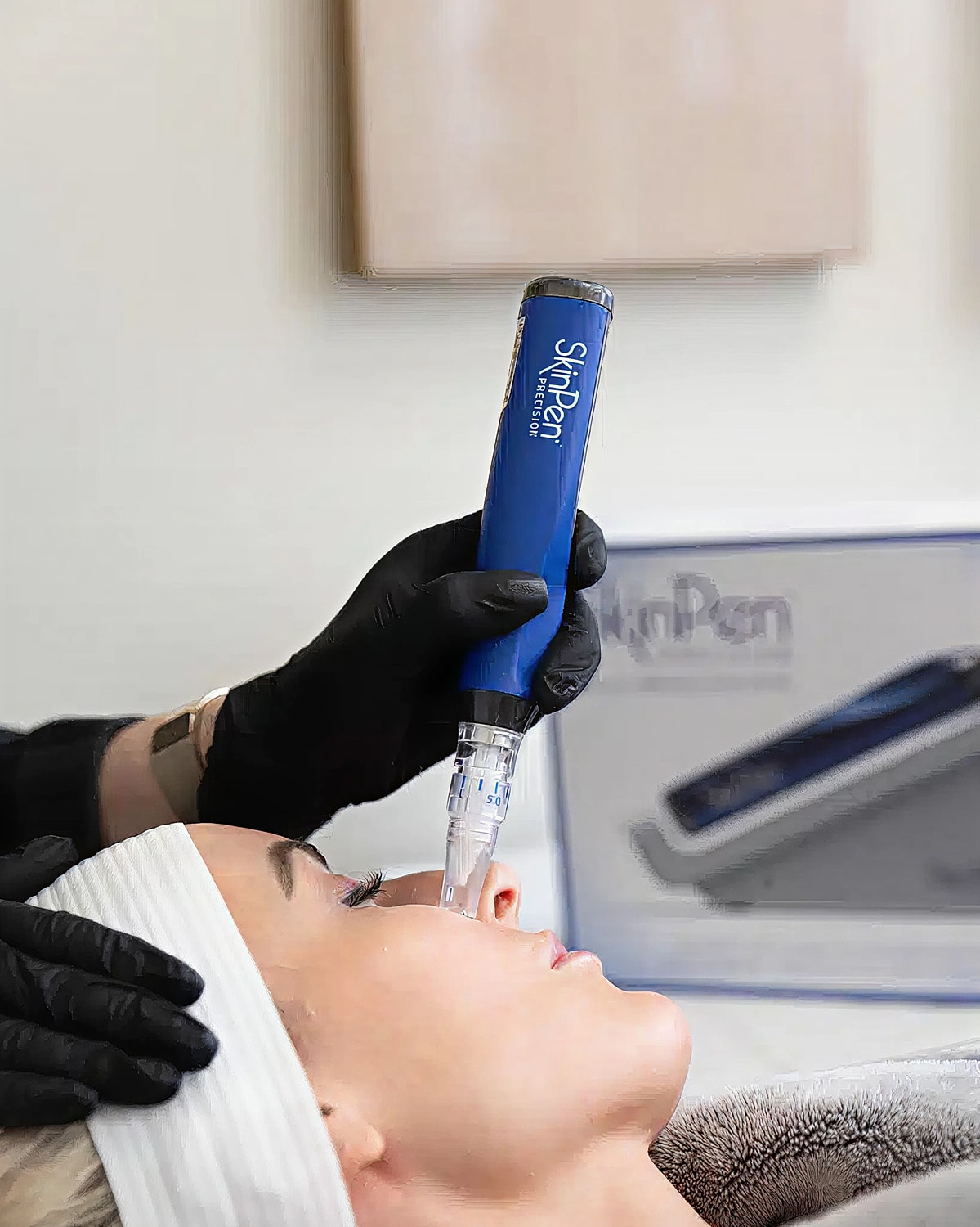 Microneedling treatment in progress with SkinPen.