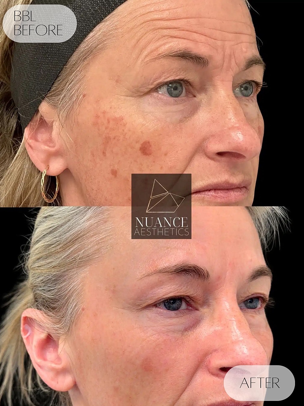 Bbl Laser Before & After