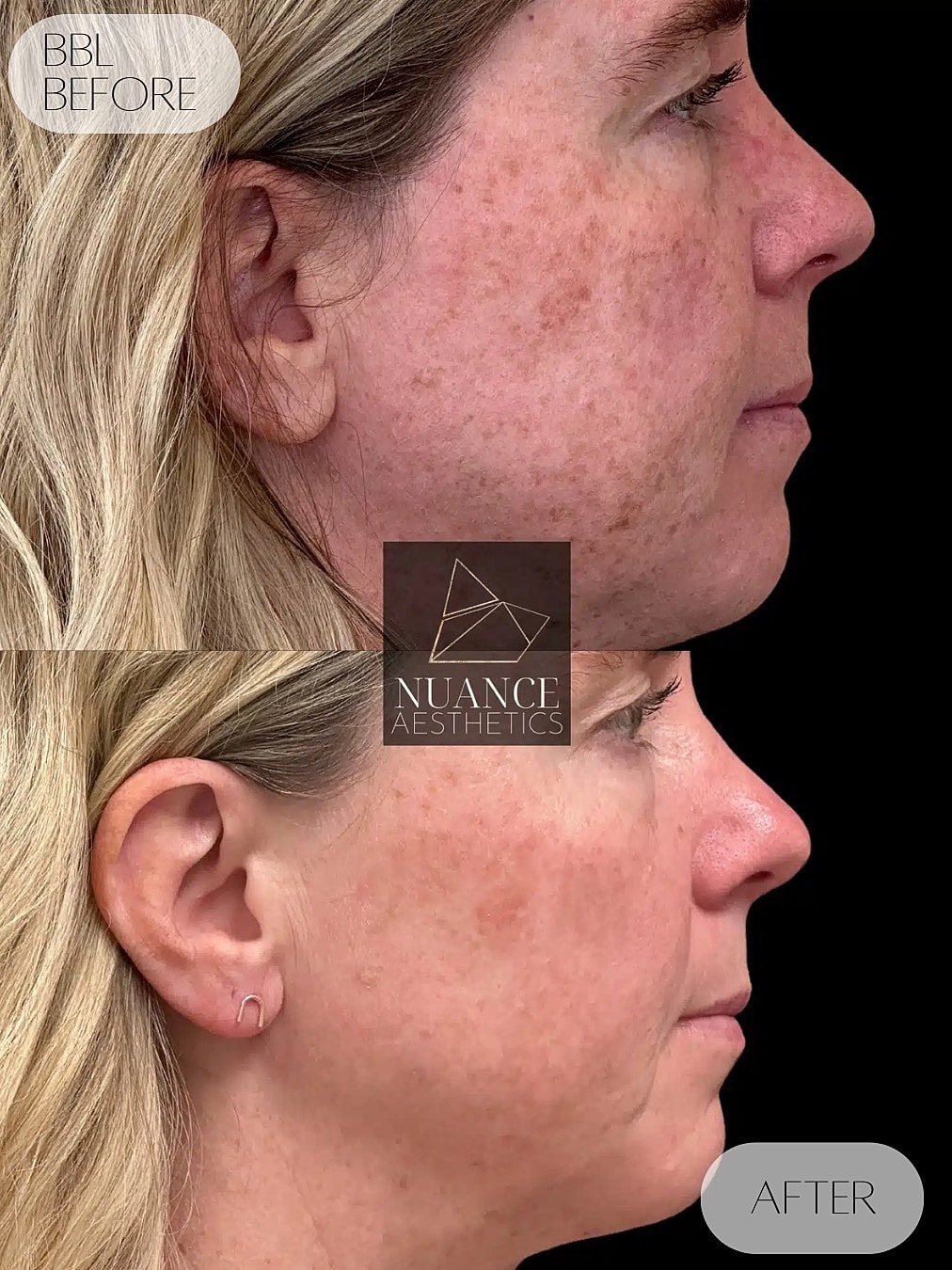 Bbl Laser Before & After