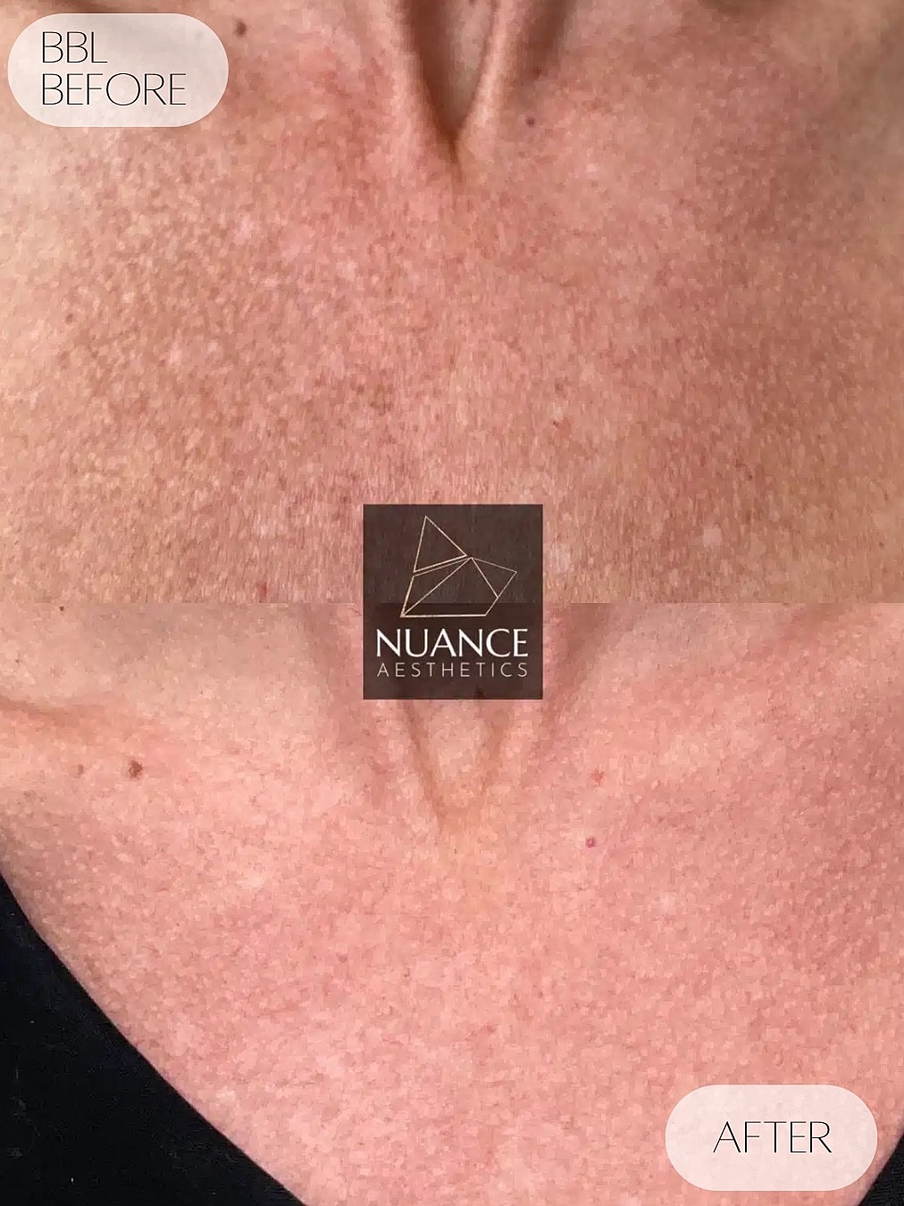 Bbl Laser Before & After