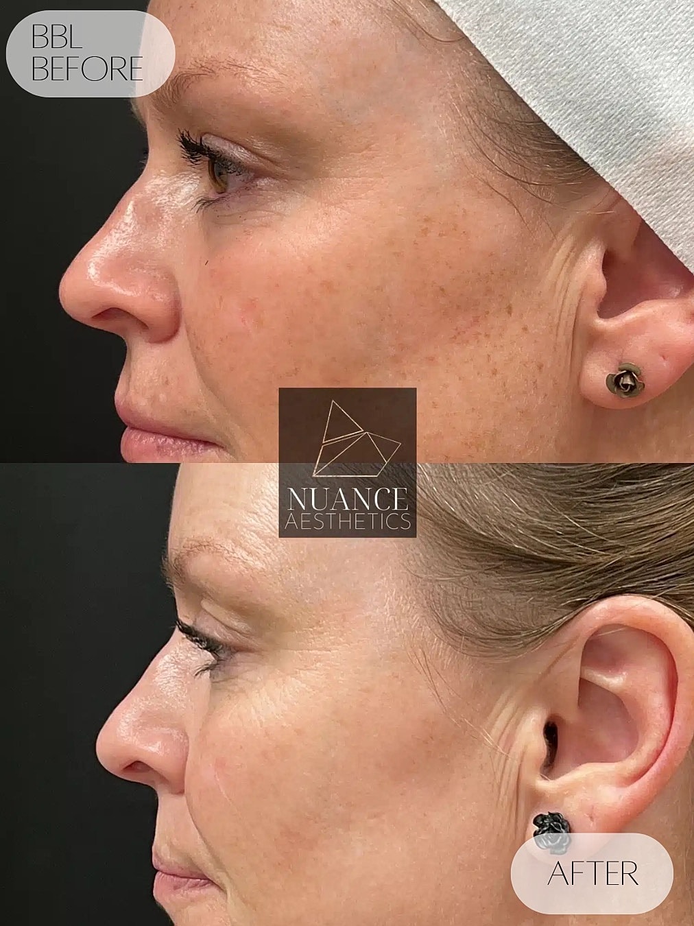 Bbl Laser Before & After