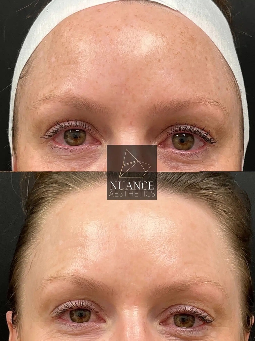 Bbl Laser Before & After
