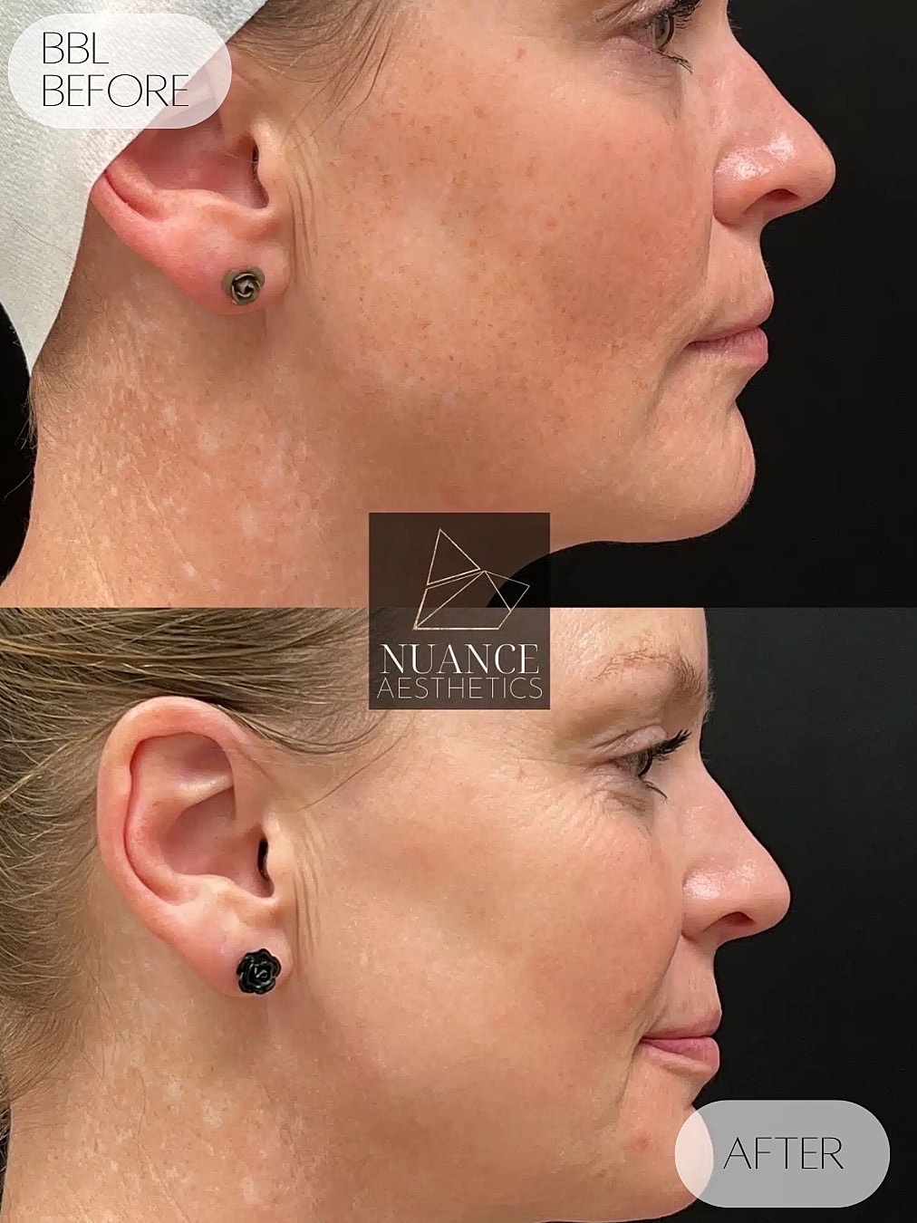 Bbl Laser Before & After