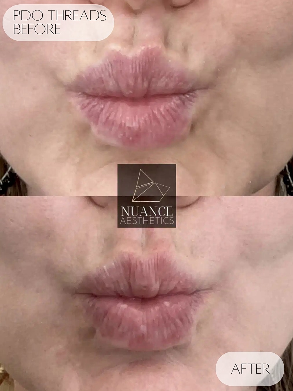 Pdo Threads Before & After