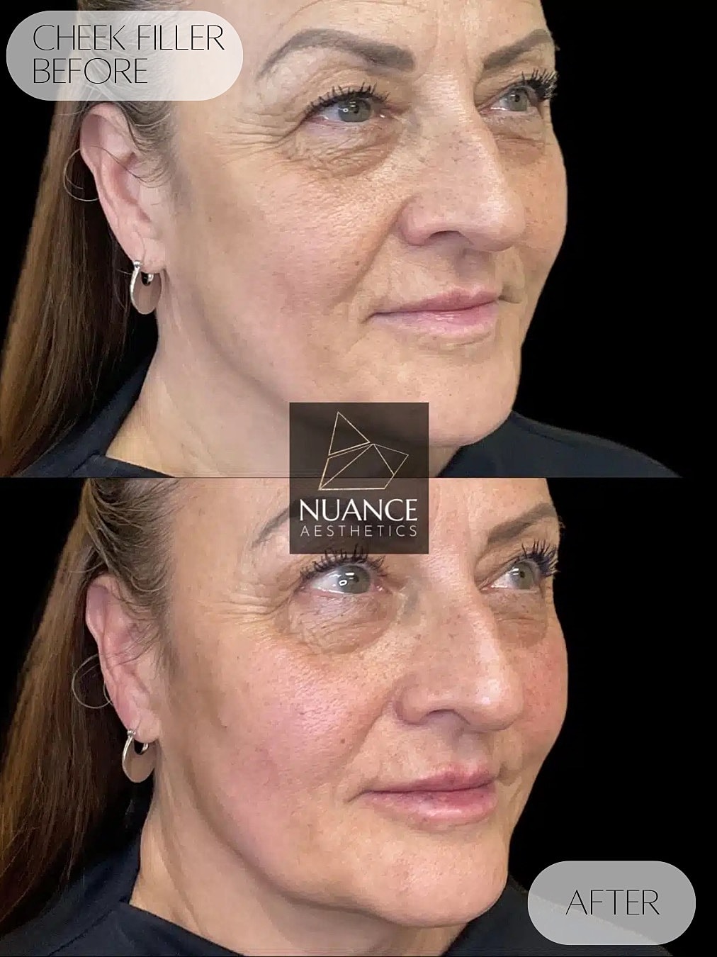 Cheek Filler Before & After