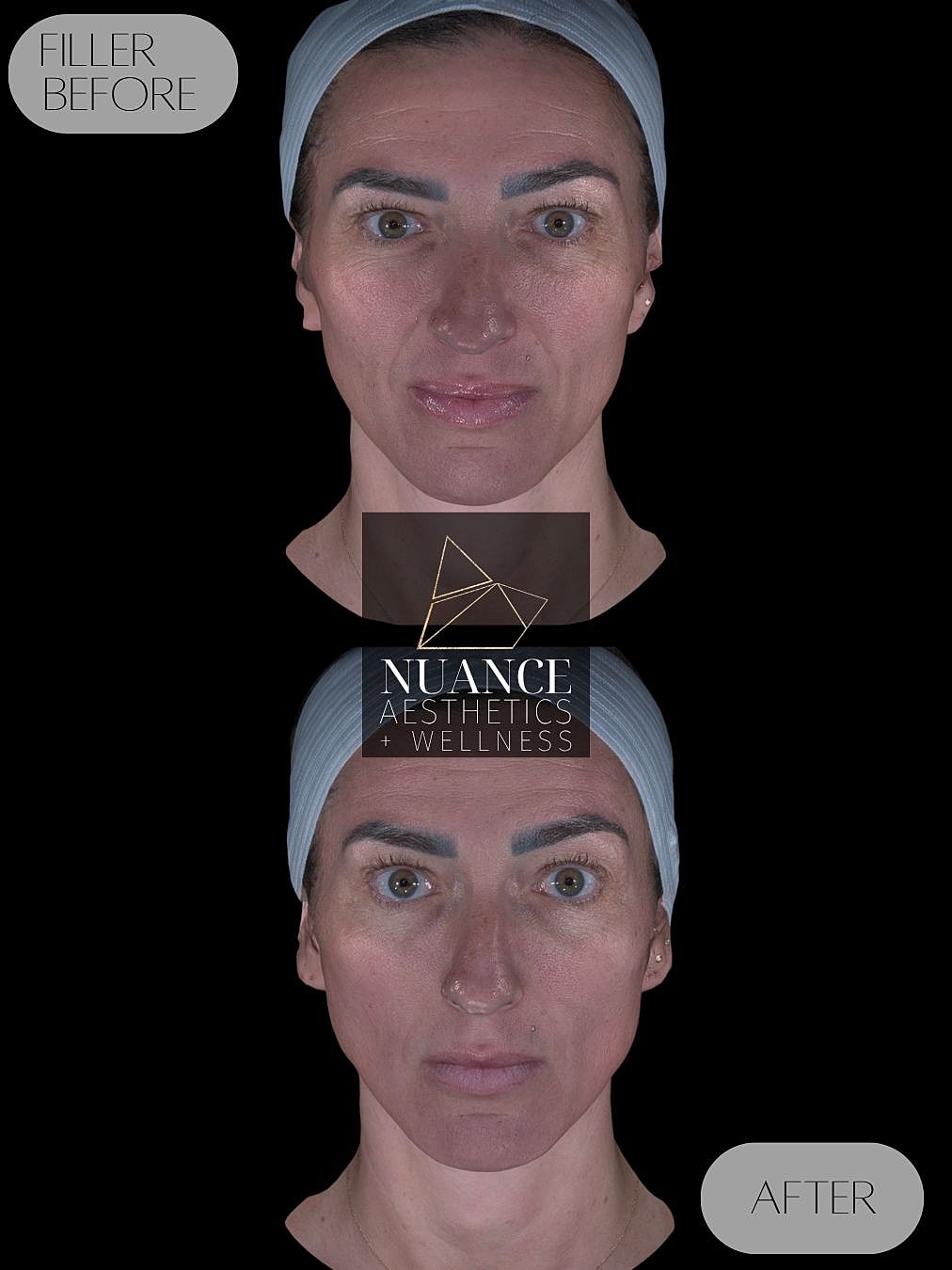 Cheek Filler Before & After