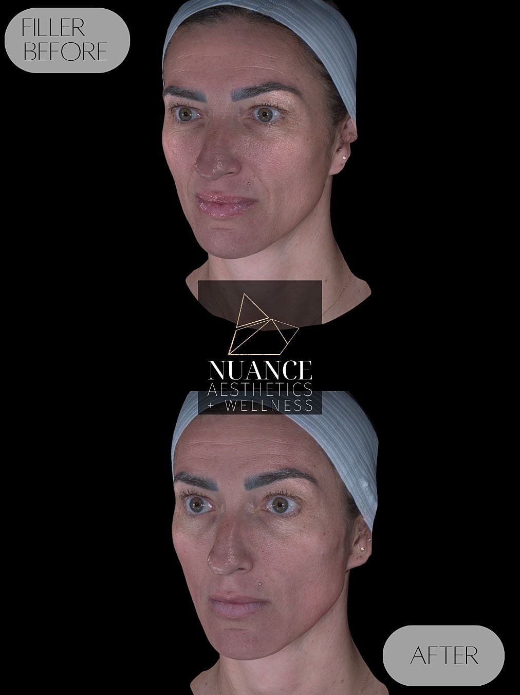 Cheek Filler Before & After