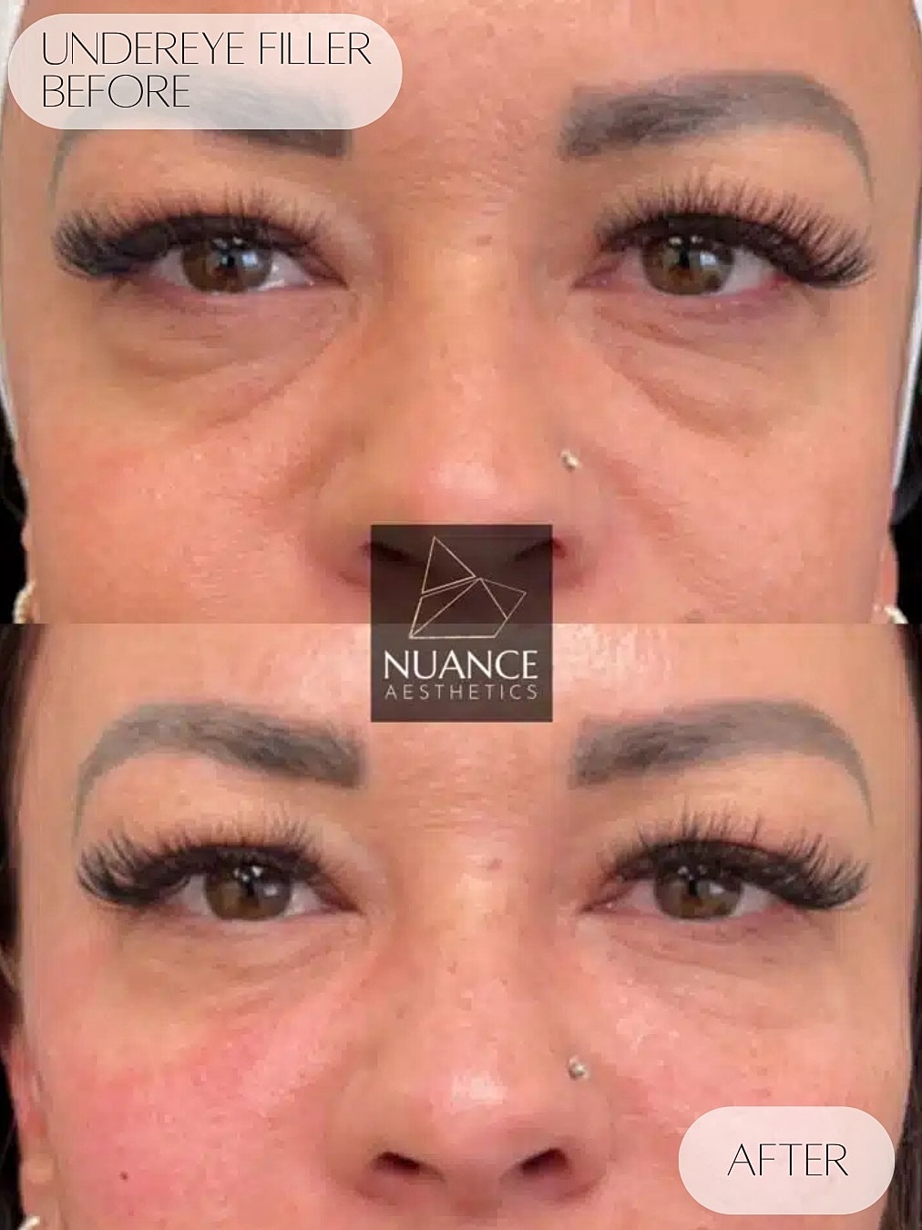 Under Eye Injections Before & After