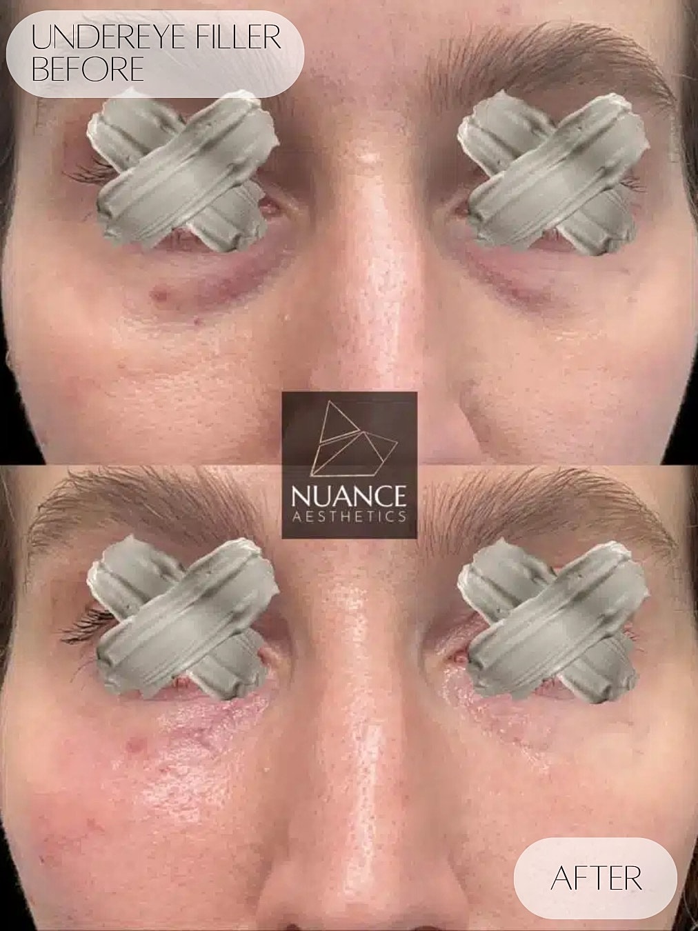 Under Eye Injections Before & After