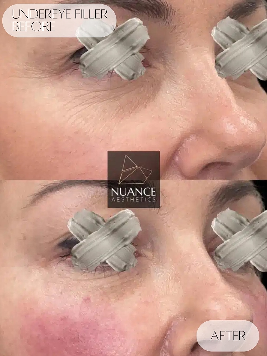 Under Eye Injections Before & After