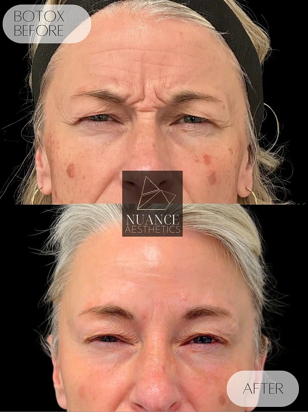 Botox Before & After
