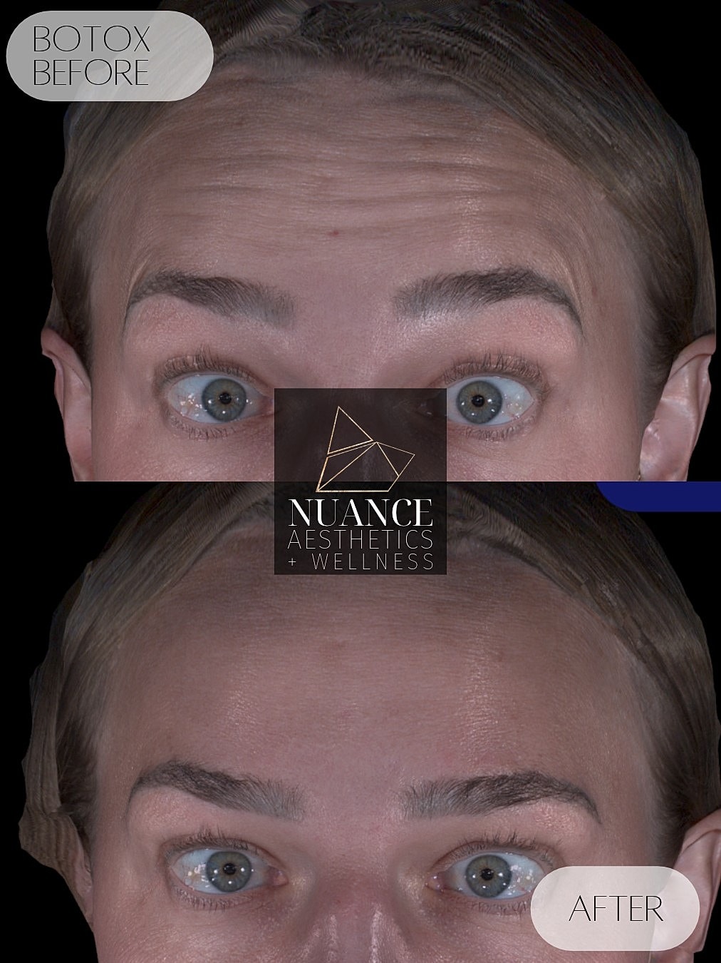 Botox® Before & After