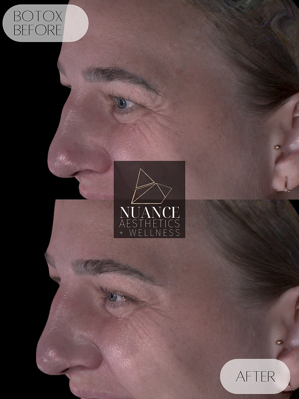Botox® Before & After