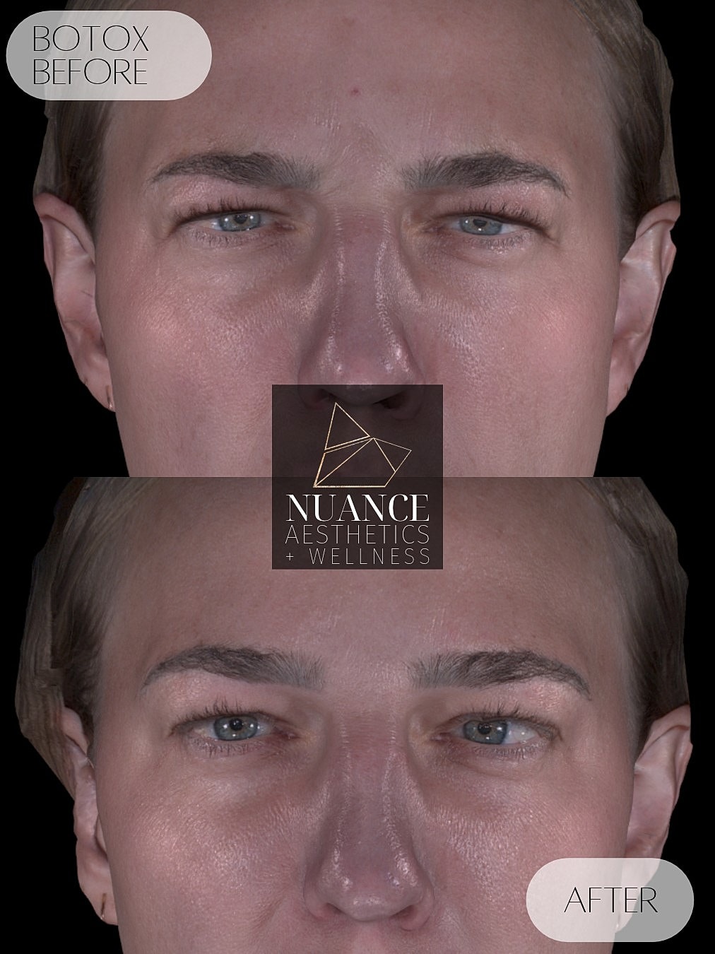 Botox® Before & After