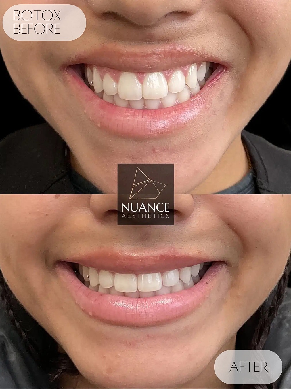 Botox Before & After