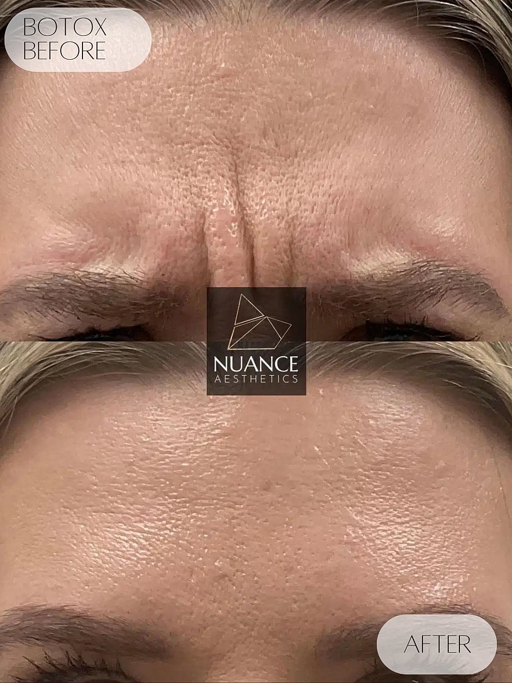 Botox Before & After