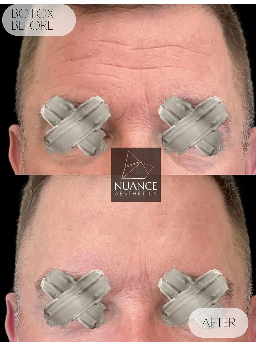 Botox Before & After