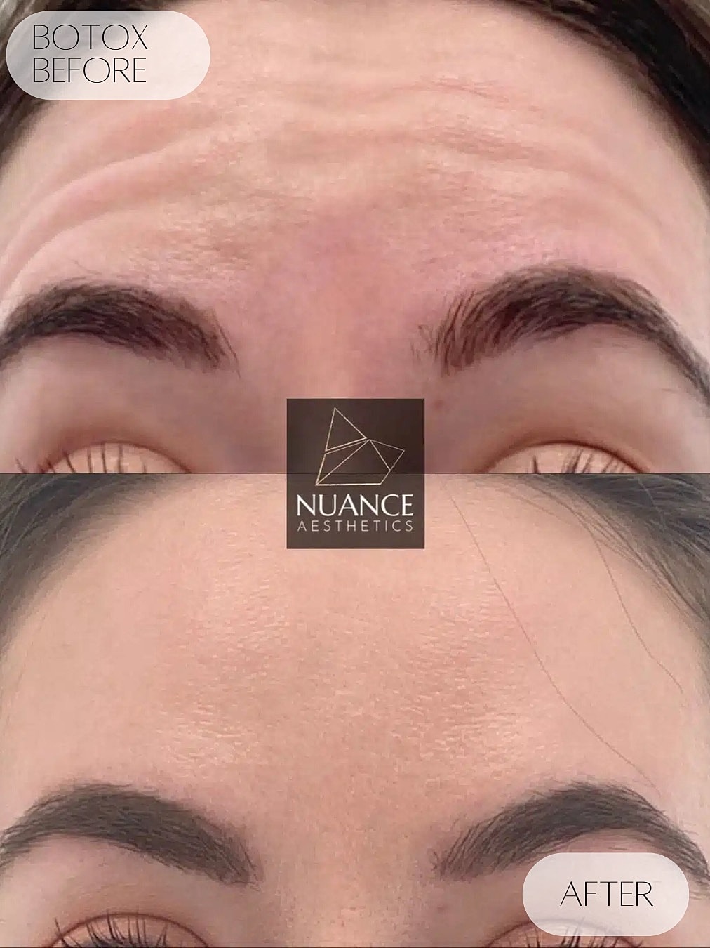 Botox Before & After