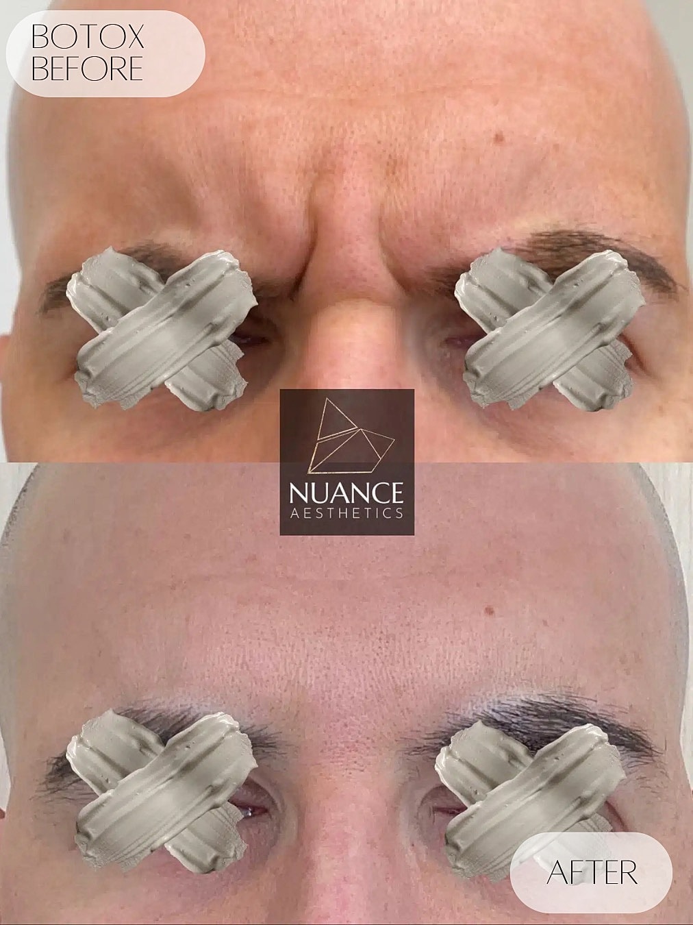 Botox Before & After