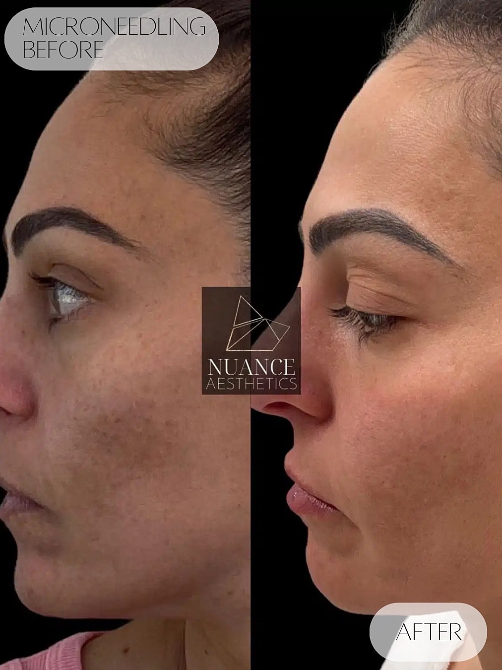 Microneedling Before & After