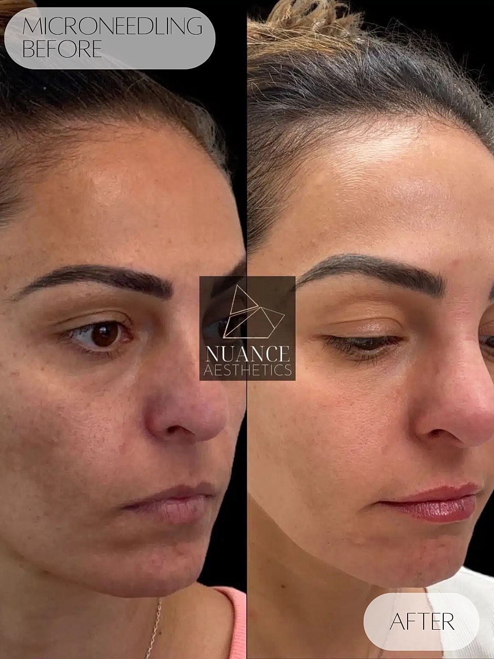 Microneedling Before & After