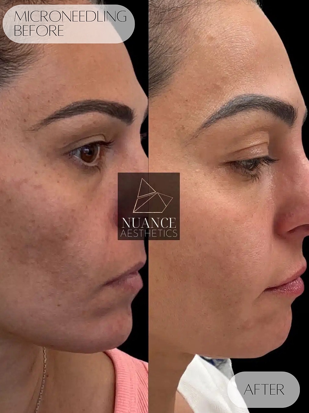 Microneedling Before & After