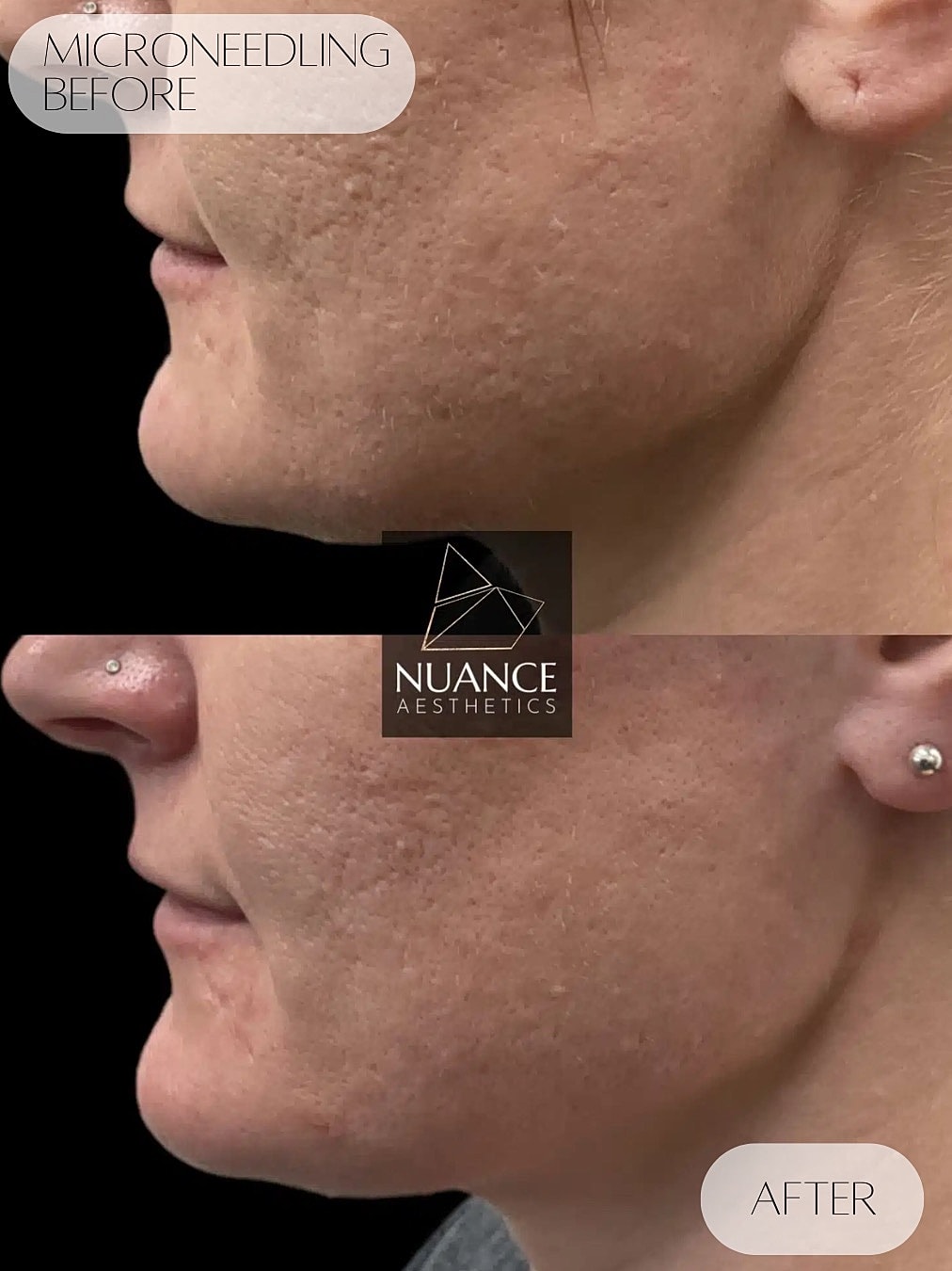 Microneedling Before & After