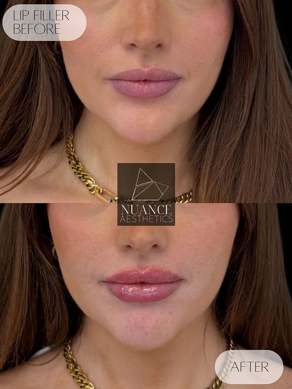 Lip Filler Before & After