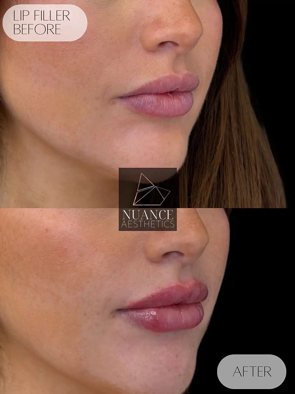 Lip Filler Before & After