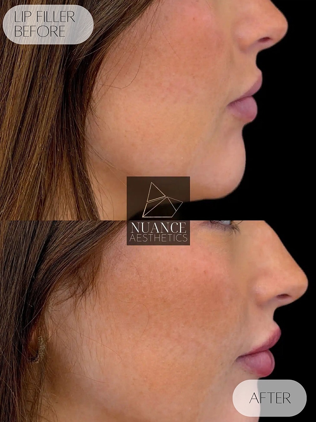 Lip Filler Before & After