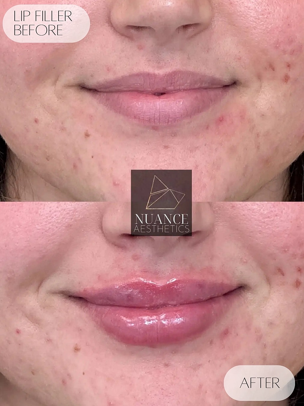 Lip Filler Before & After