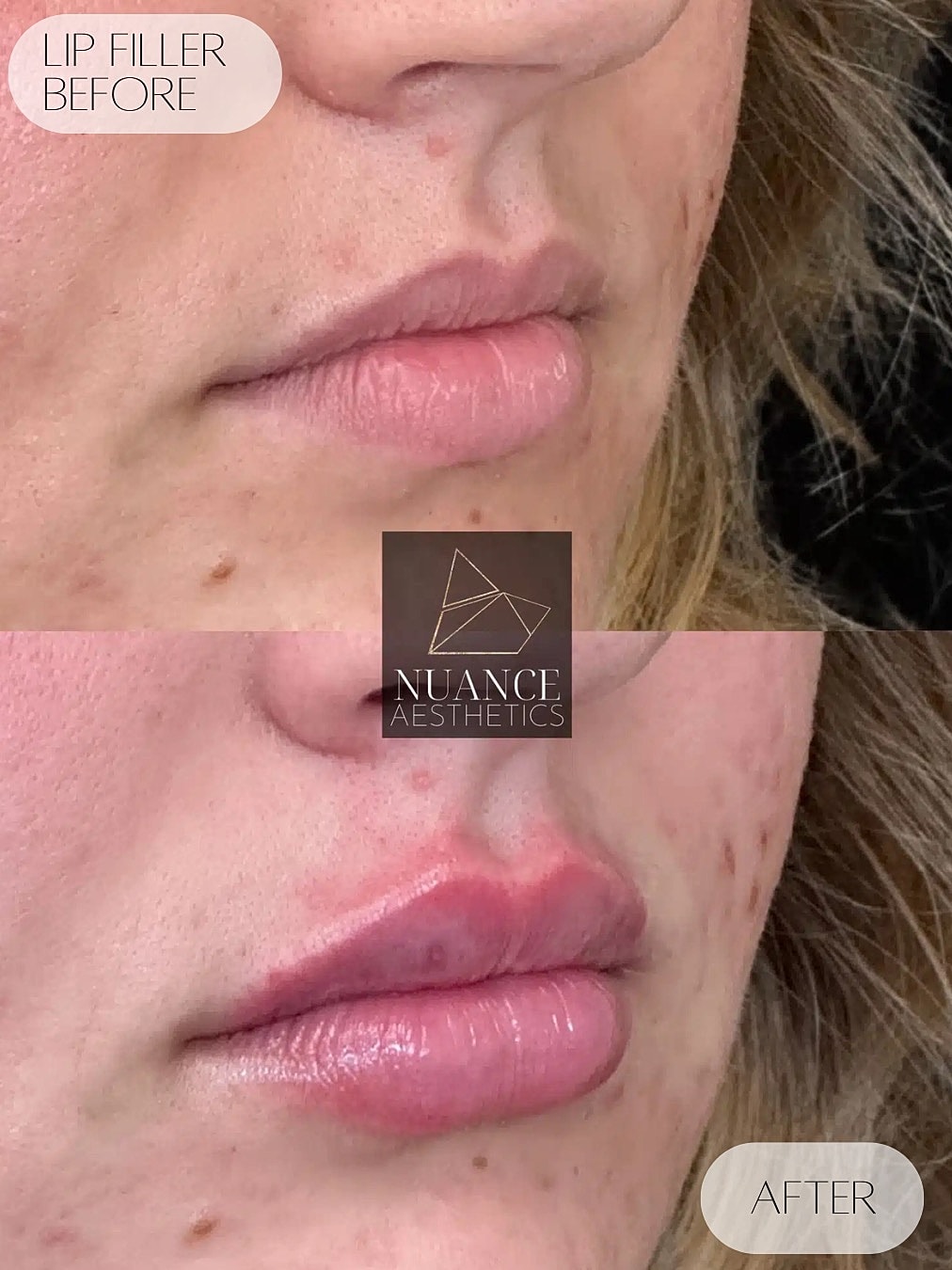 Lip Filler Before & After