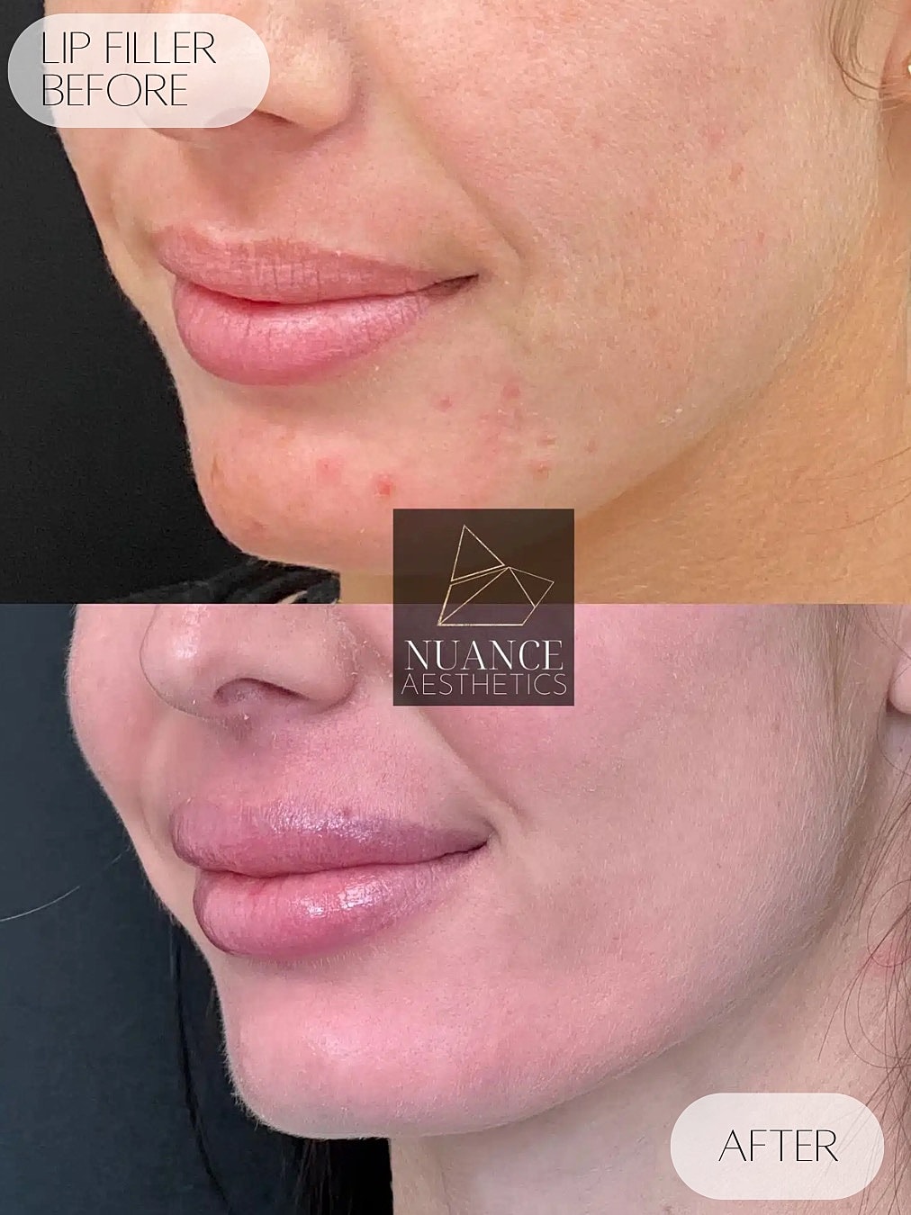 Lip Filler Before & After