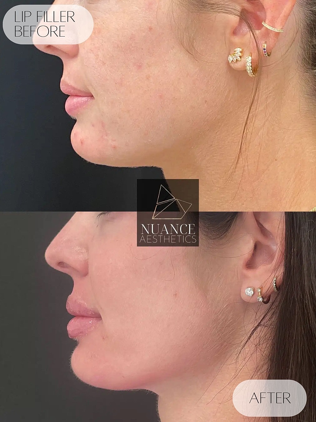 Lip Filler Before & After