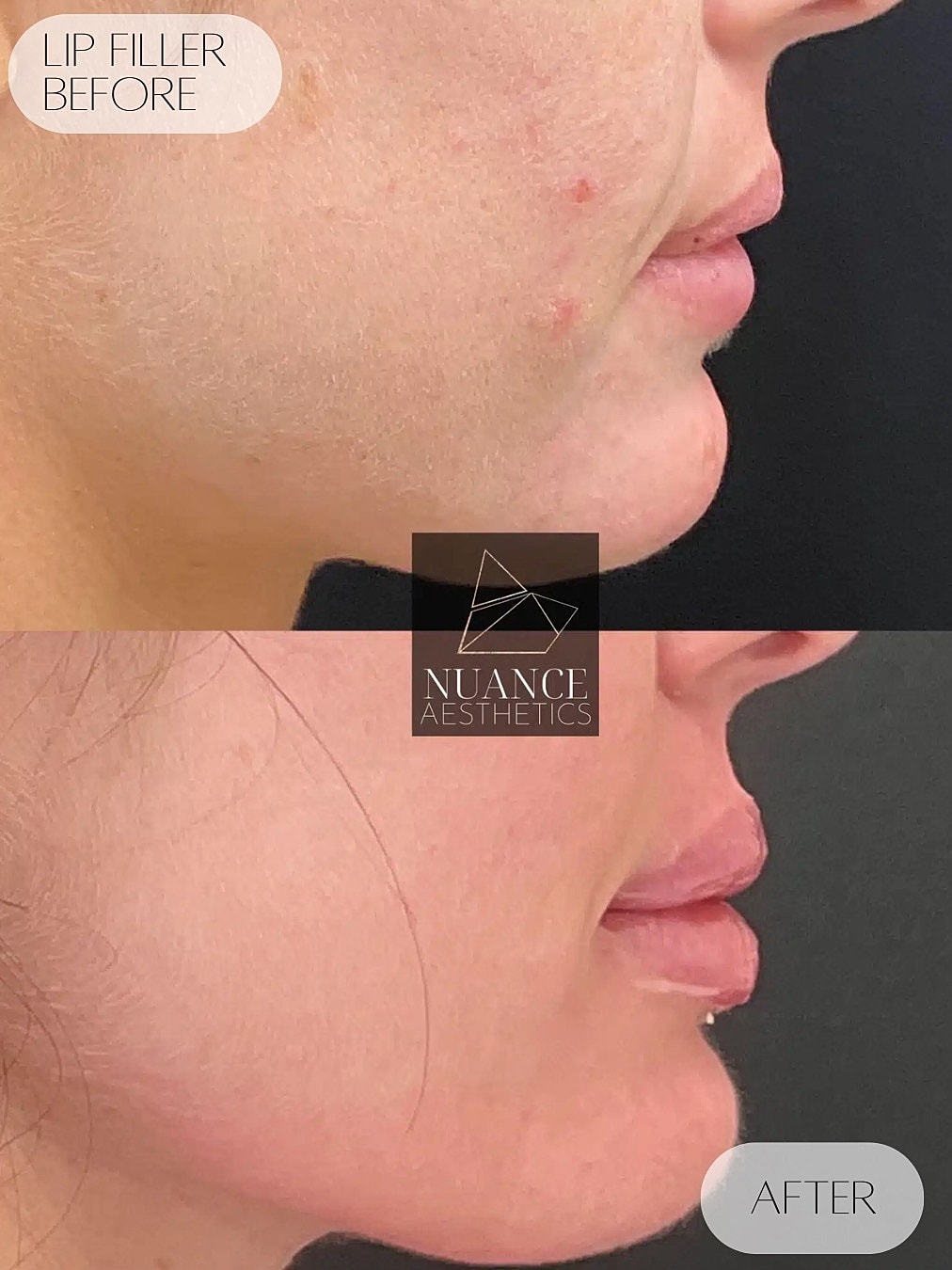 Lip Filler Before & After