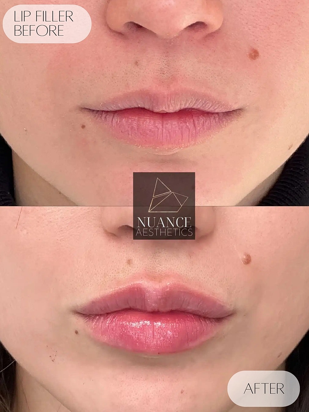 Lip Filler Before & After