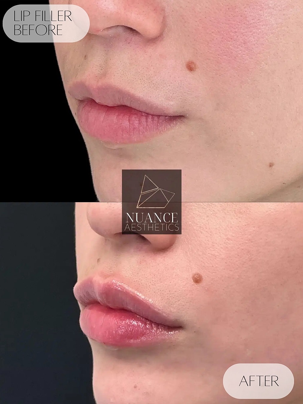 Lip Filler Before & After