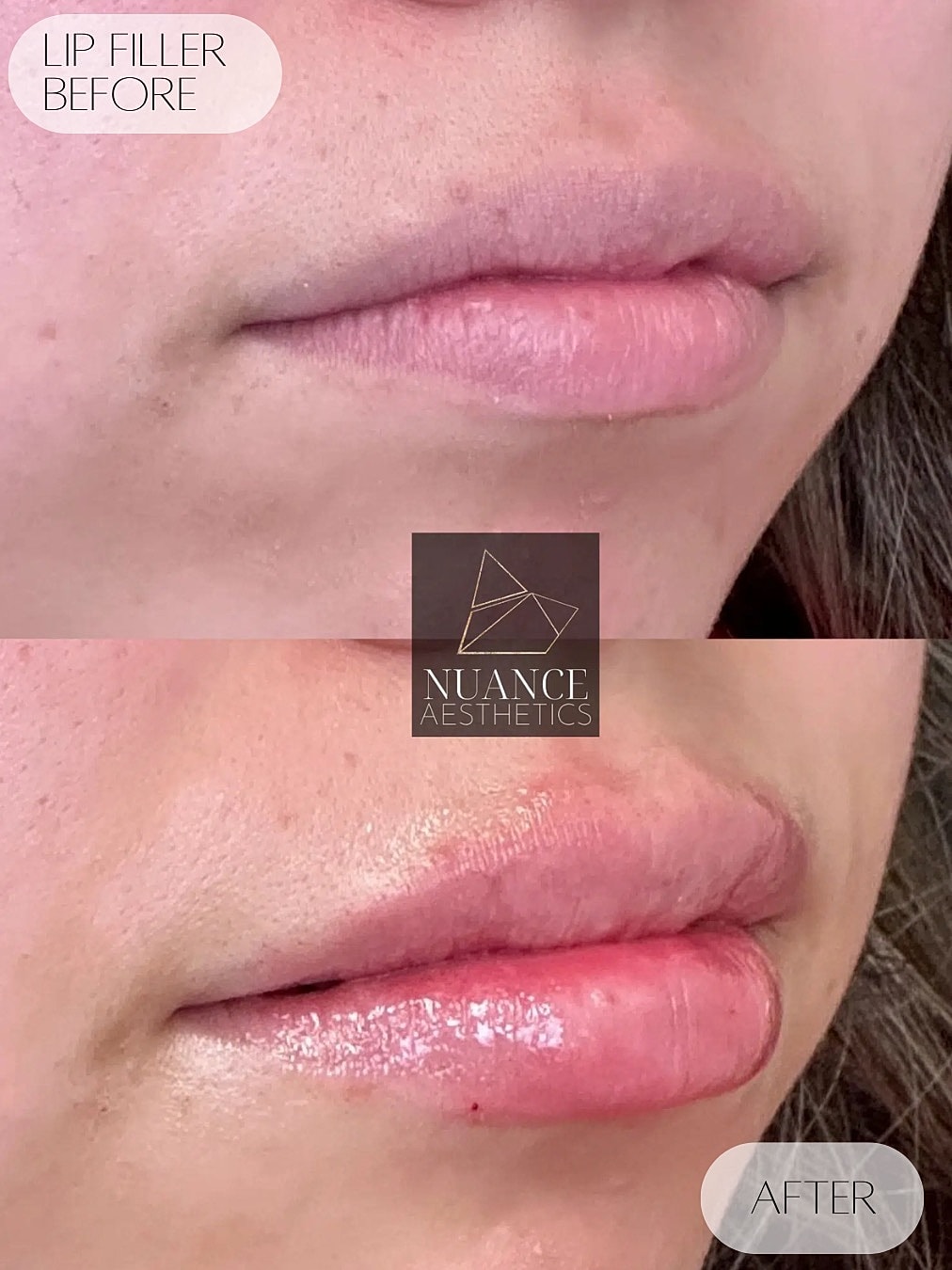 Lip Filler Before & After