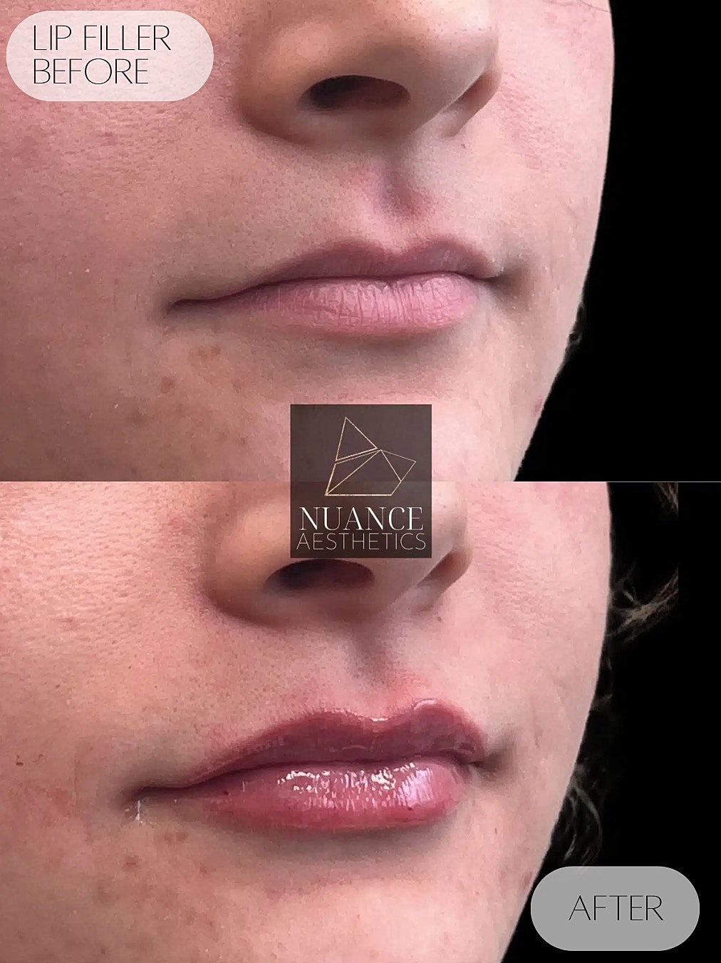 Lip Filler Before & After