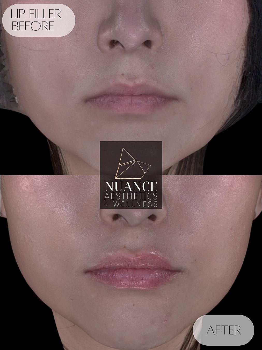 Lip Filler Before & After