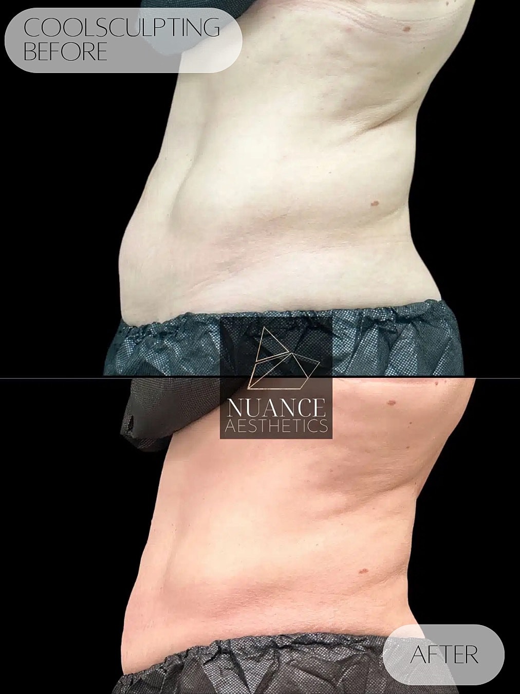 CoolSculpting Before & After