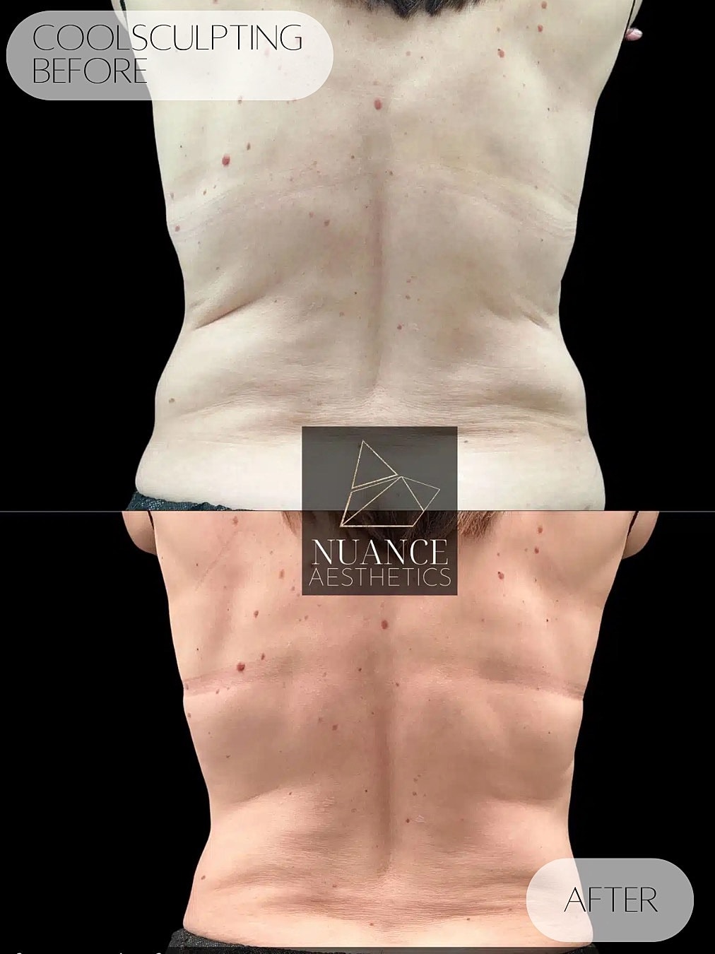 CoolSculpting Before & After