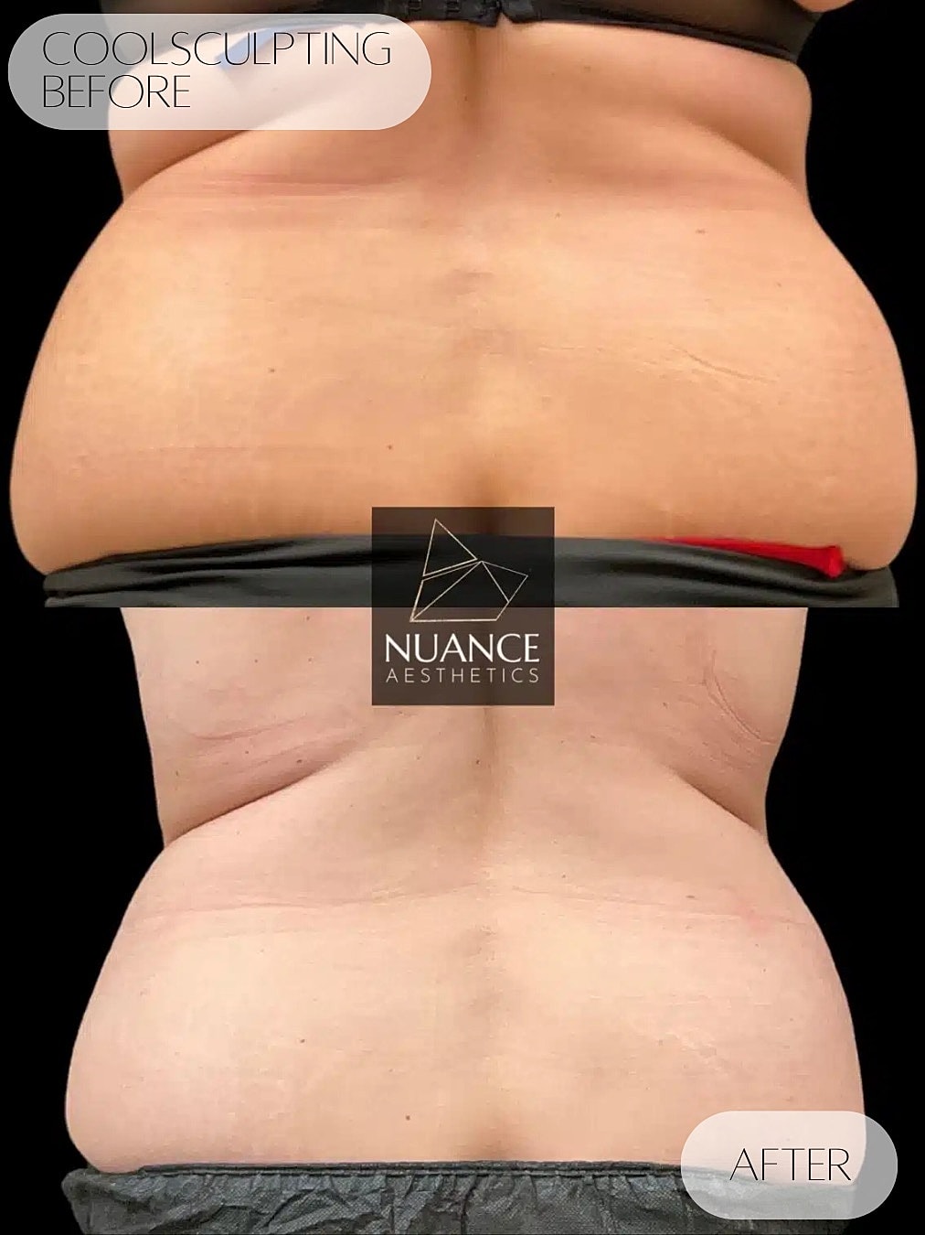 Coolsculpting Before & After