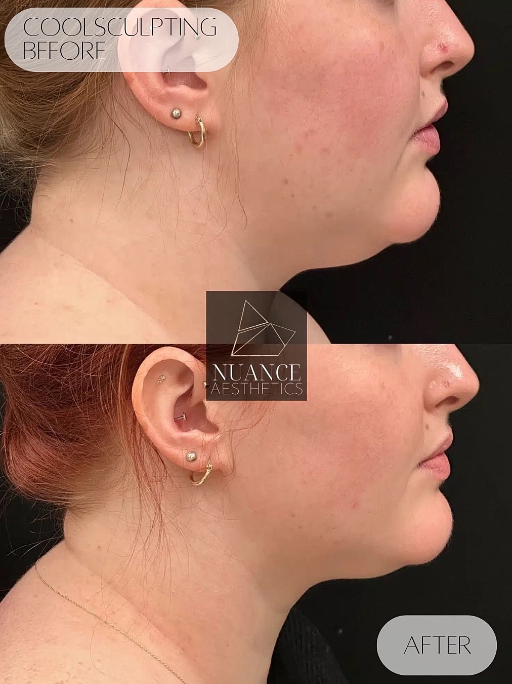 Coolsculpting Before & After