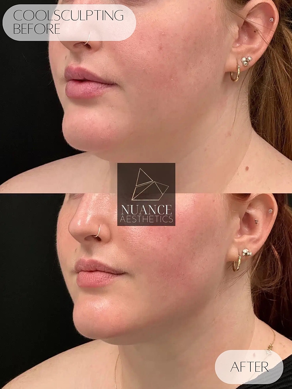 Coolsculpting Before & After