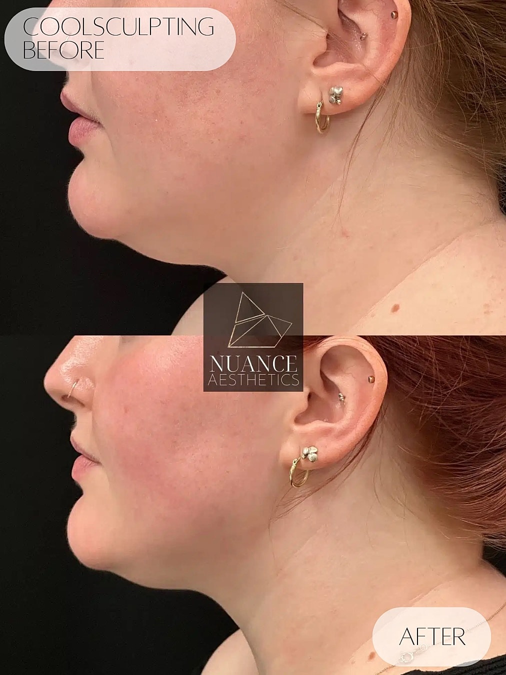 Coolsculpting Before & After